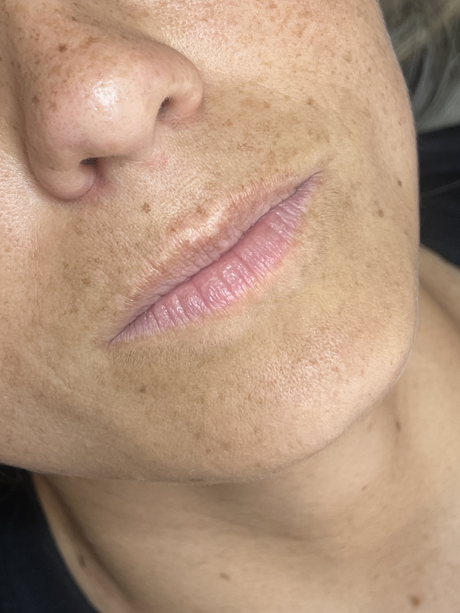 Nuze antes do ajuste de contorno e volume labial